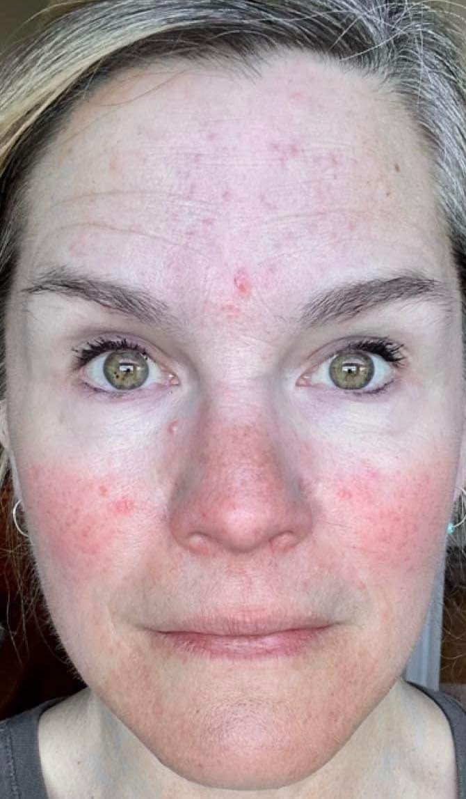 Before and after images showcasing the transformative effects of No More Make Up Skin Corrector: left side reveals skin with visible imperfections, right side shows clear, radiant, and improved skin texture after one week of use.