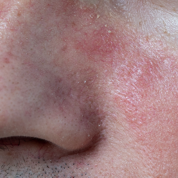 Eliminate redness with just a few applications of No More Make Up Skin Corrector.