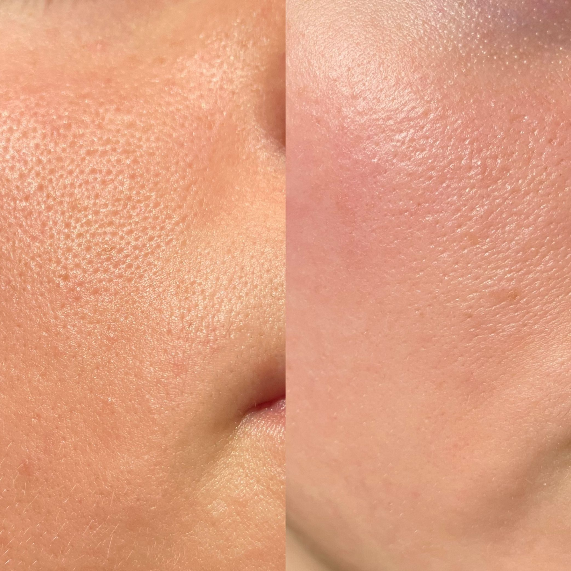 Before and after comparison demonstrating significant large pore improvement with No More Make Up Skin Corrector, showcasing visibly refined and smoother skin texture after use.
