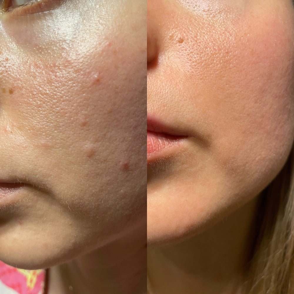 Before and after transformation of acne-prone skin with No More Make Up Skin Corrector, revealing clear, smooth skin and a significant reduction in blemishes and redness for those with acne concerns.